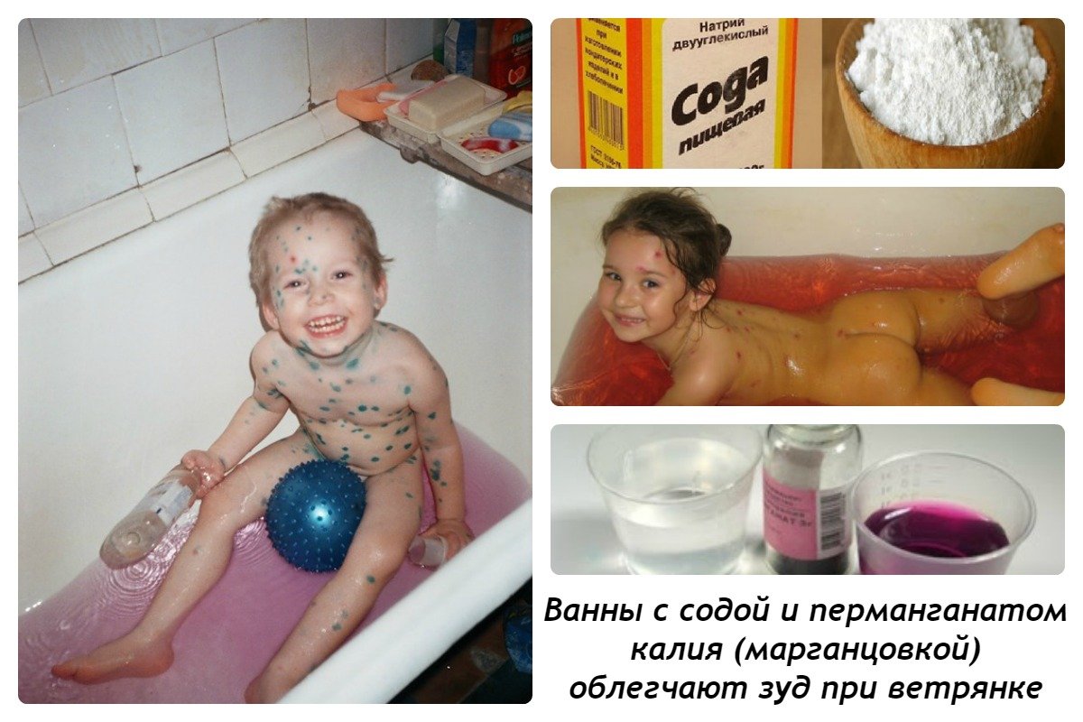 Ветрянка у детей: лечение