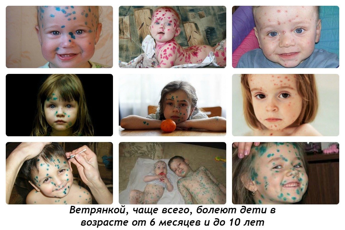Ветрянка у детей: фото