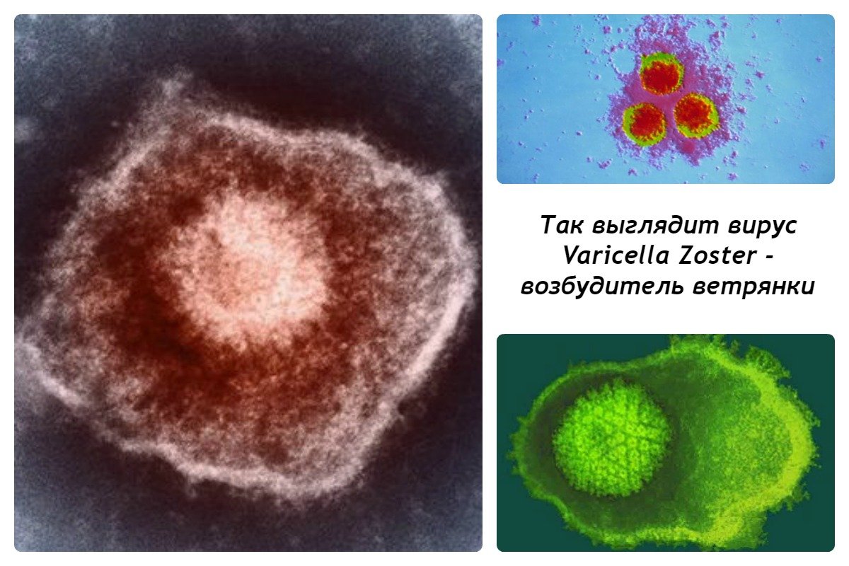 Ветрянка у детей: так выглядит вирус Varicella Zoster, вызывающий ветряную оспу