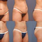 Стандартная абдоминопластика