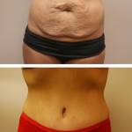 Миниабдоминопластика (ушивание кожи)