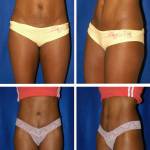 Абдоминопластика с помощью эндоскопа