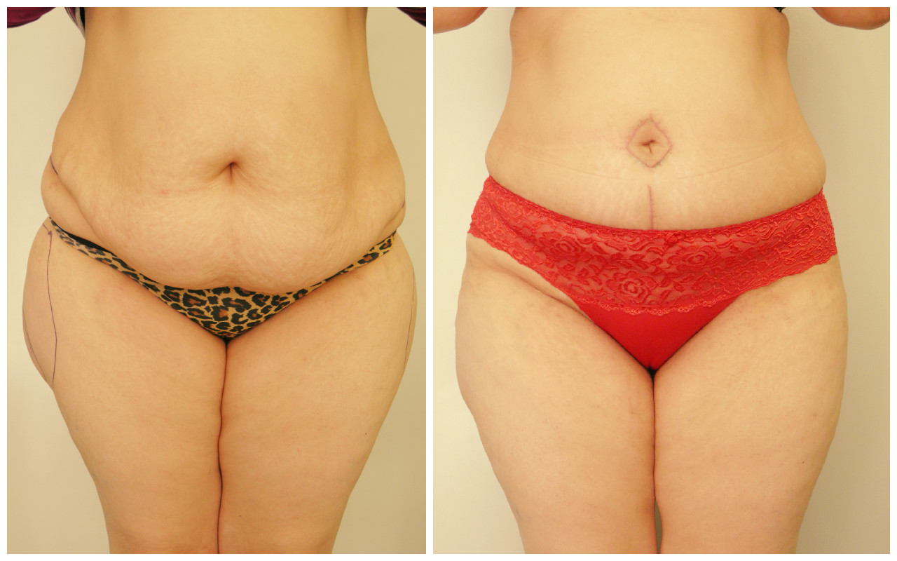 Абдоминопластика: фото до и после