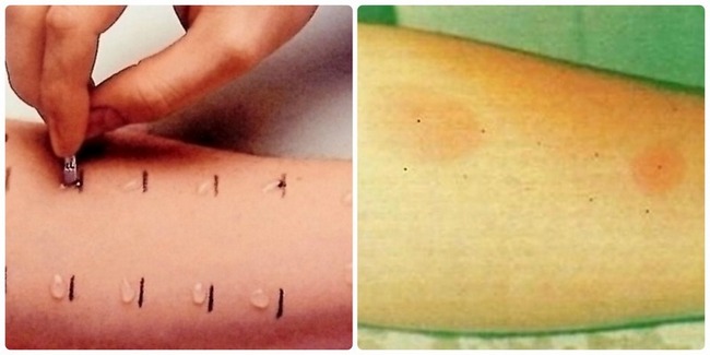 Аллергопробы