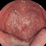 Атрофический фарингит