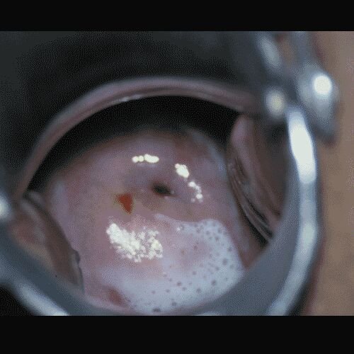 Бактериальный вагиноз