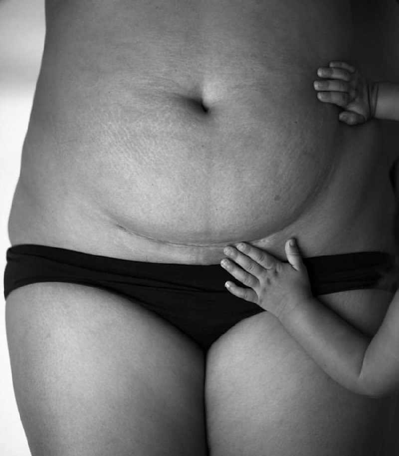 Живот после кесарева сечения