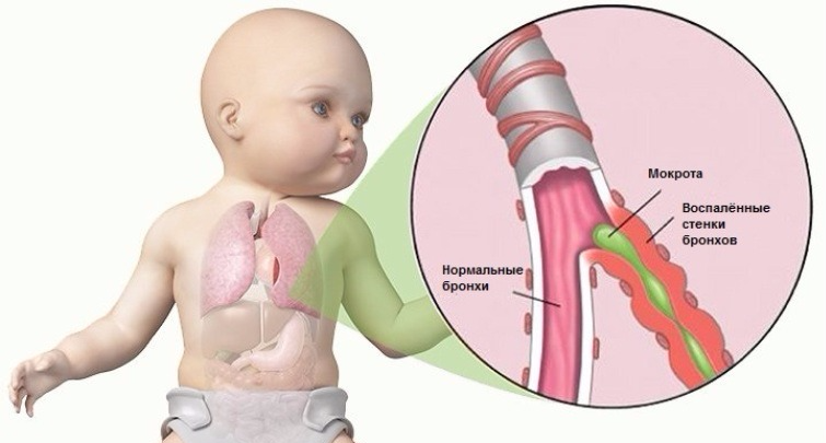 Бронхит у ребёнка
