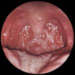 Гранулёзный фарингит