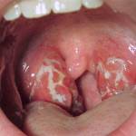 Хронический тонзиллит