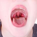 Хронический тонзиллит у детей