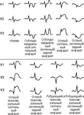 расшифровка экг