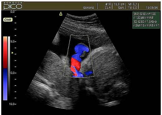 Доплер УЗИ при беременности