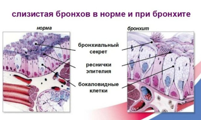 Изменения слизистой при бронхите