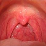 Катаральный фарингит