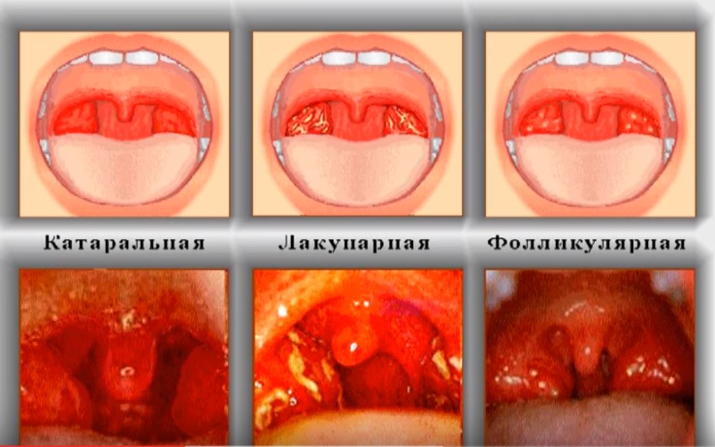 Распространённые виды вирусной ангины: катаральный, лакунарный и фолликулярный