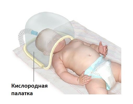 Кислородотерапия