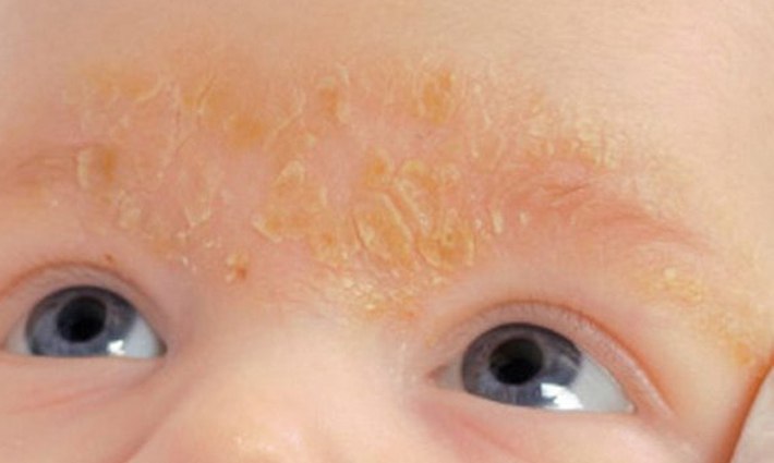 Корочки на бровях у ребёнка