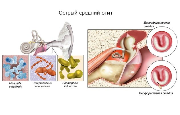 Острый средний отит