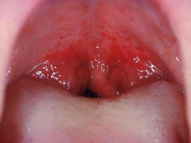 Острый фарингит