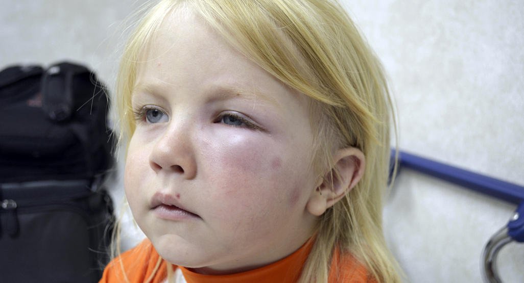 Отёк Квинке у ребёнка