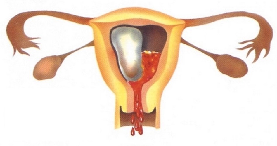 Выкидыш в ходу