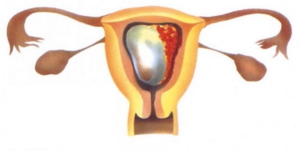 Начало самопроизвольного аборта