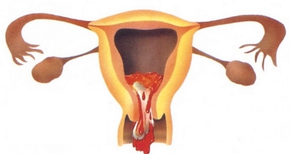 Свершившийся выкидыш