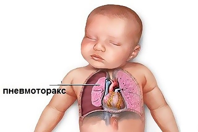 пневмоторакс у новорождённого