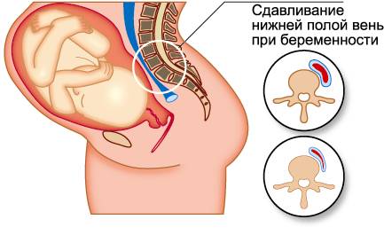 Схема расположения нижней полой вены у беременных
