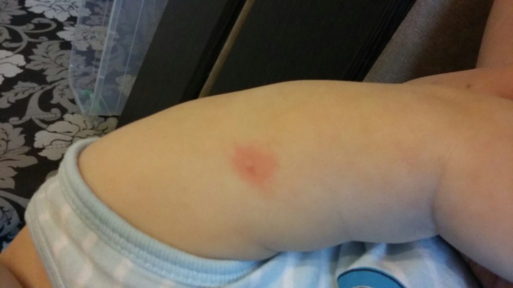 Ранка на коже ребёнка после введния вакцины