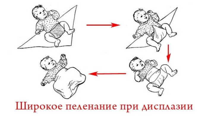 Алгоритм широкого пеленания младенца с дисплазией суставов