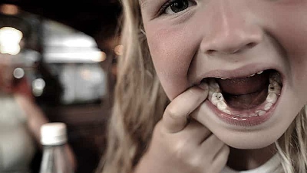 Девочка с открытым ртом, её зубы поражены кариесом