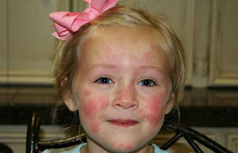 У девочки аллергическая сыпь на лице