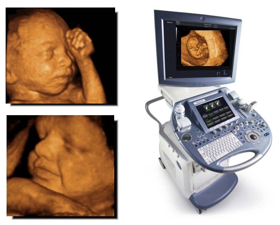 3Д УЗИ