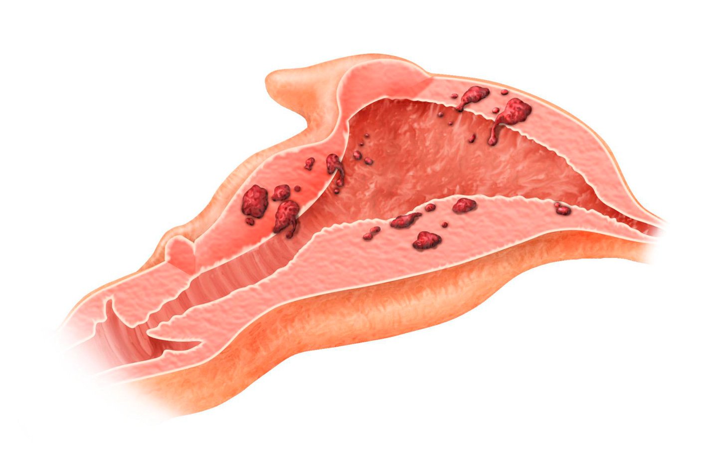 Как выглядит матка с аденомиозом