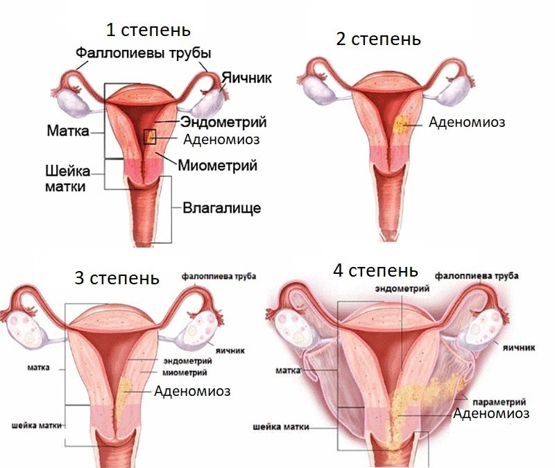 Степени аденомиоза