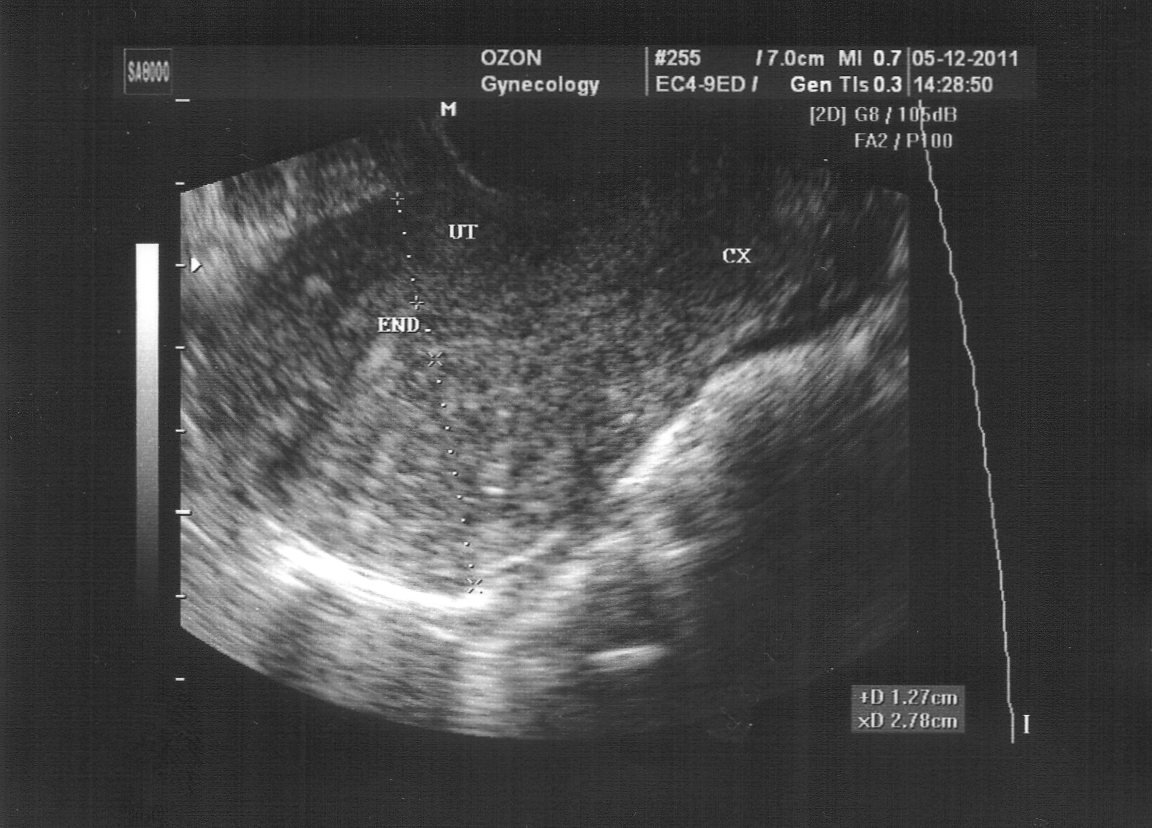 Как выглядит аденомиоз матки на УЗИ