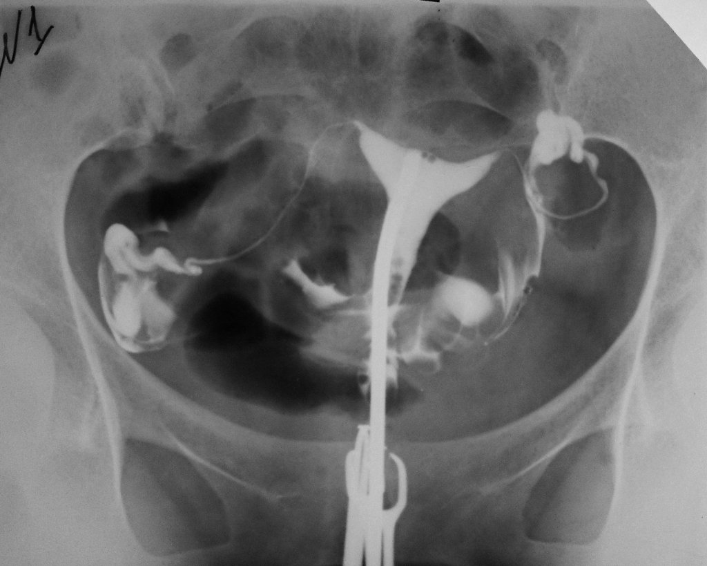 Рентгеновский снимок матки и её придатков