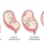 Нормальная плацента и виды плаценты с предлежанием