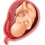 Преждевременная отслойка плаценты