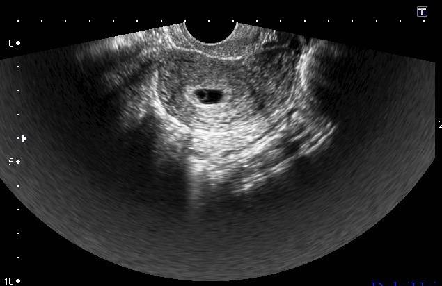 УЗИ-картина плодного яйца