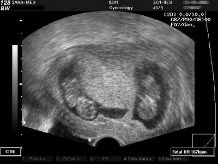 УЗИ-картина двух плодов в матке