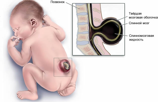 Менингоцеле (схема)