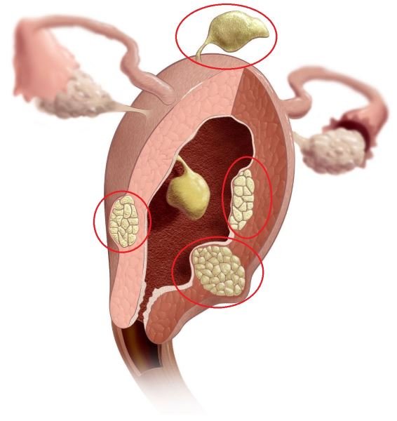 Миома матки (схема)