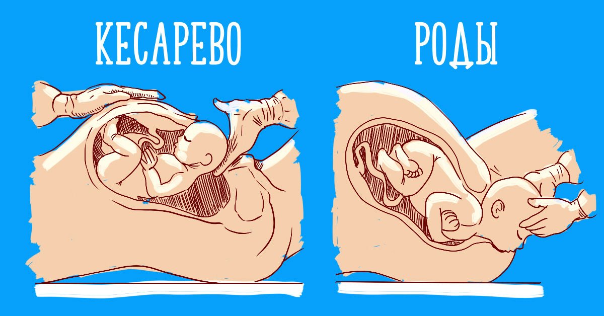 Изображение: естественные роды и кесарево сечение