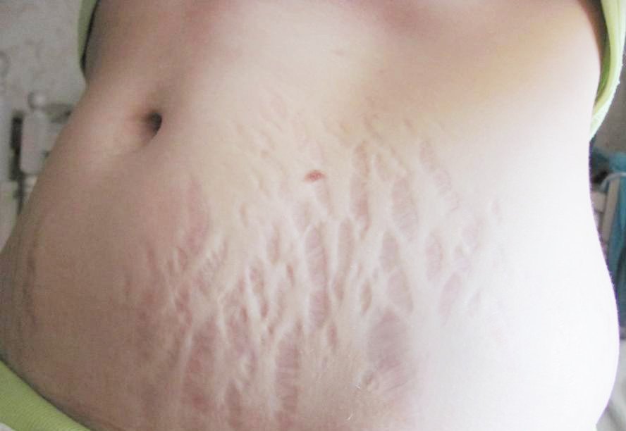 Растяжки на животе