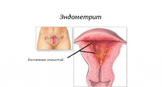 Эндометрит