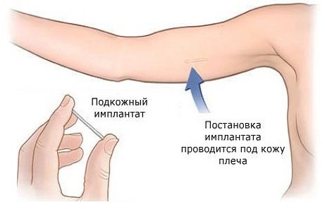 Подкожный контрацептивный имплантант (гормональный контрацептив)