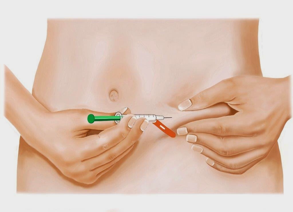 укол в живот женщины на схеме